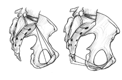 Estrecho superior e inferior de la pelvis, en un plano sagital