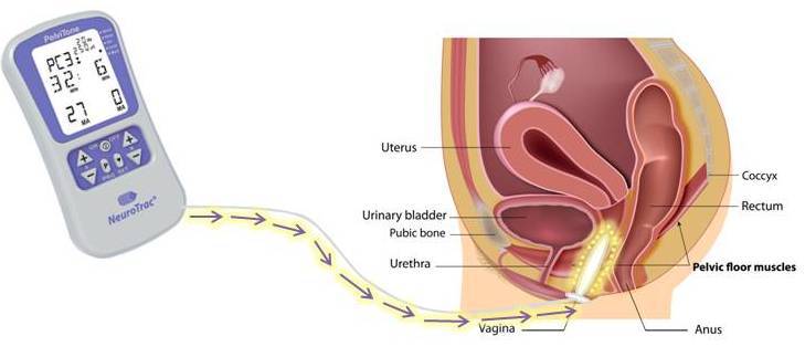 Programas de electroestimulación para incontinencia urinaria